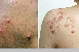 Acne Scar Treatment in Islamabad, Pakistan