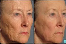 Anti Aging Treatment in Islamabad