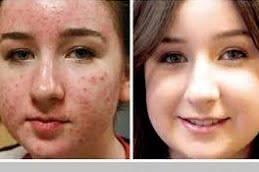Best Acne Scar Clinic in Islamabad