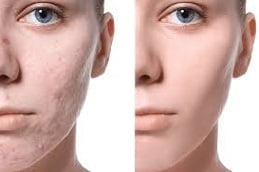 Best Acne Scar Treatment in Islamabad, Pakistan