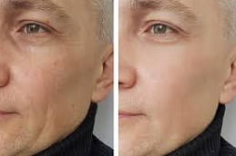 Best Anti Aging Treatment in Islamabad