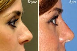 Best Clinic for Non Surgical Nose Job in Islamabad