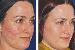Best Dermapen Treatment Clinic in Islamabad