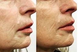 Best Dermapen Treatment in Islamabad