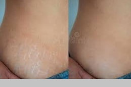 Best Fine Lines Wrinkles before & After in Islamabad