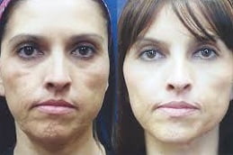 dermal Fine Lines Wrinkles in Islamabad