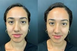 Best Hydrafacial in Islamabad