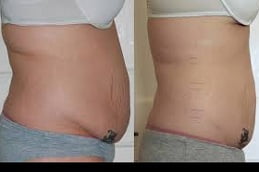 Best Laser Liposuction in Islamabad