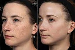 Best Laser Skin Tightening Clinic in Islamabad