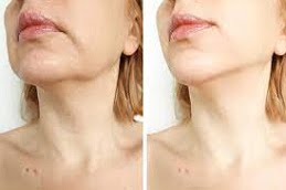 Best Laser Skin Tightening in Islamabad