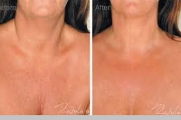 Best Mesotherapy Treatment Clinic in Islamabad