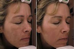 Best Mesotherapy in Islamabad, Pakistan