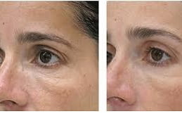 Best Mesotherapy in Islamabad