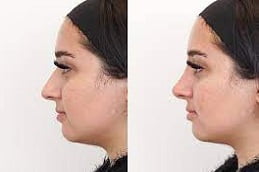 Best Non Surgical Nose Job Clinic in Islamabad