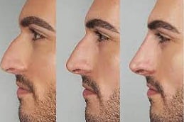 Best Non Surgical Nose Reshaping in Islamabad