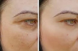 Best PRP Treatment in Islamabad