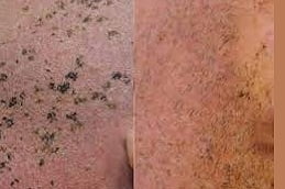 Best Pigmentation Treatment in Islamabad