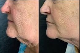 Best Skin Tightening Clinic in Islamabad