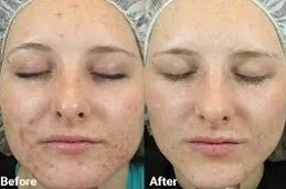 Best Skin Whitening Treatment in Islamabad