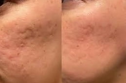 Dermapen Clinic in Islamabad