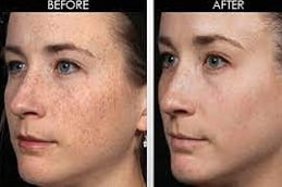 Dermapen Treatment in Islamabad, Pakistan