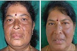 Dermapen Treatment in Islamabad