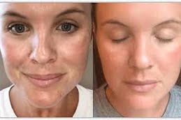 Facial PRP Treatment in Islamabad, Pakistan