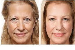 Facial PRP Treatment in Islamabad
