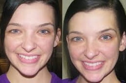 Fine Lines & Wrinkle Clinic Treatment in Islamabad