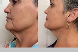 botox injection Fine Lines Wrinkles before & after