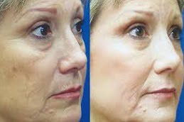 Botox Fine Lines and Wrinkles in Islamabad, Pakistan