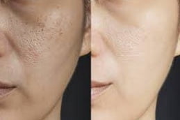 Gluthathione Injections in Islamabad