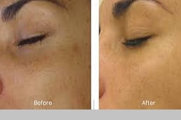 Hydrafacial Treatment in Islamabad, Pakistan