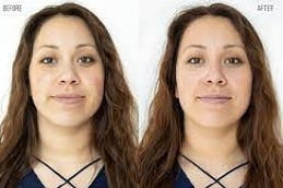 Hydrafacial in Islamabad