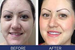 Hydrafacial in Islamabad, Pakistan
