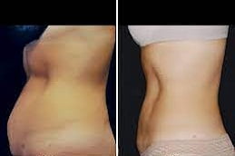 Laser Liposuction in Is;lamabad, Pakistan