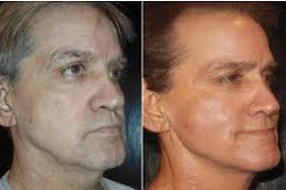 Laser Skin Tightening Clinic in Islamabad