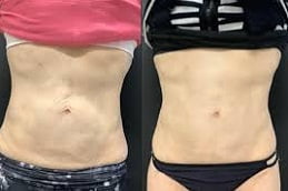 Laser Skin Tightening in Islamabad, Pakistan