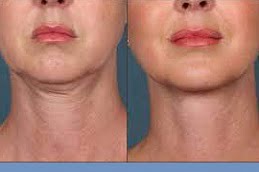 Laser Skin Tightening in Islamabad