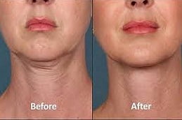 Mesotherapy Treatment Clinic in Islamabad, Pakistan