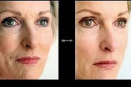 Mesotherapy Treatment Clinic in Islamabad