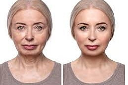 Mesotherapy Treatment in Islamabad