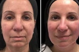 Mesotherapy for Skin Clinic in Islamabad