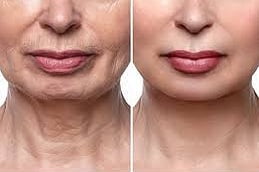 Mesotherapy for Skin Clinic in Islamabad,Pakistan