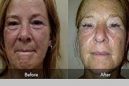 Mesotherapy for Skin in Islamabad, Pakistan