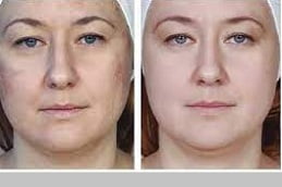 Mesotherapy for Skin in Islamabad