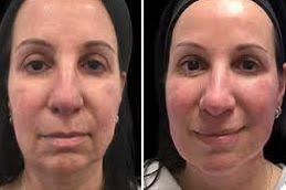 Mesotherapy in Islamabad