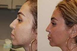Non Surgical Nose Job in Islamabad, Pakistan