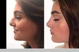 Non Surgical Nose Job in Islamabad