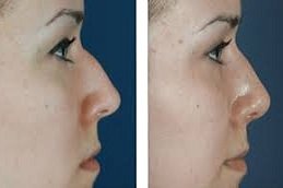 Non Surgical Rhinoplasty in Islamabad